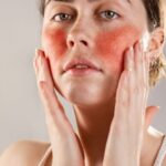 Managing Redness and Flare-ups With Expert Care