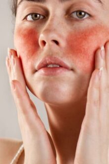 Managing Redness and Flare-ups With Expert Care